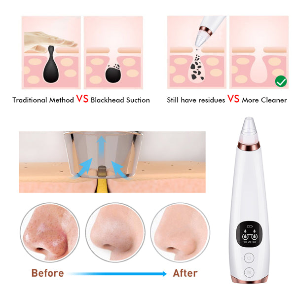 Facial Pore Cleaner – Vacuum Blackhead Remover with 5 Interchangeable Heads